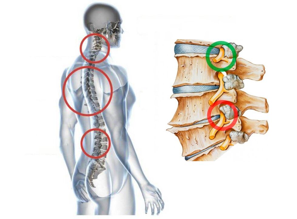 Ինչպիսին է vertebrae- ի արգանդի վզիկի օստեոխոնդրոզը